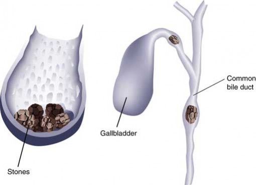 Gall Bladder Stone Indian Diet To Lose Weight