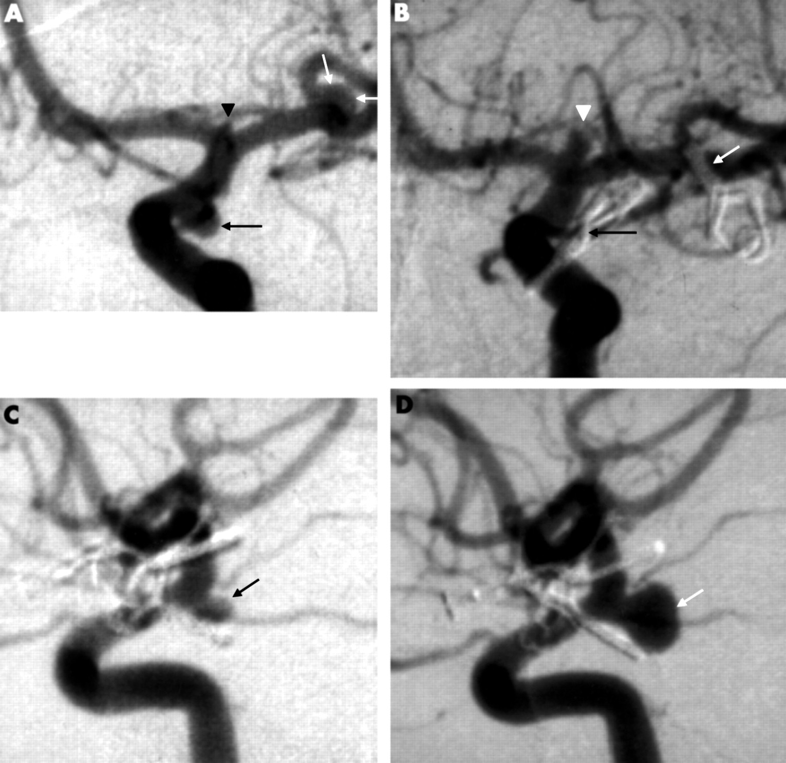 Diamond Blackfan Anemia