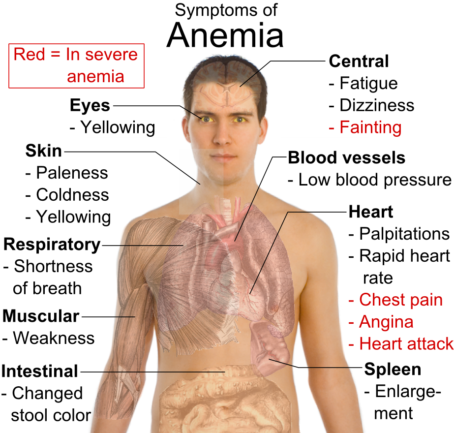 Anemia Symptoms and Causes for Anemia | MedExpress Blog