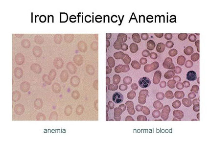 There are separate articles Childhood Anaemia and Anaemia in Pregnancy..  Symptoms of severe anaemia (usually not occurring until Hb is <7 g/dL) include:  .