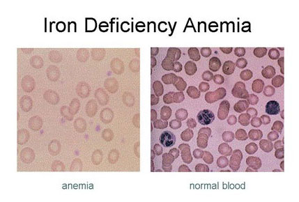 There are separate articles Childhood Anaemia and Anaemia in Pregnancy.. Symptoms of severe anaemia (usually not occurring until Hb is <7 g/dL) include: .