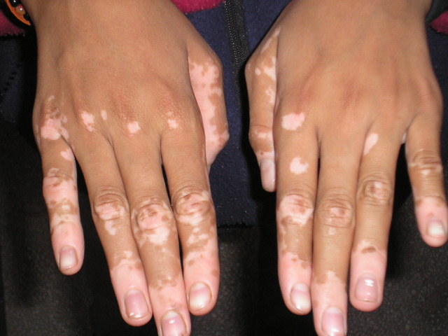 Vitiligo - Causes,Symptoms,Diet,Treatment ,White Spots on Skin