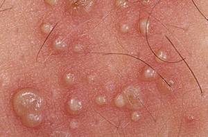 Genital Rash Women