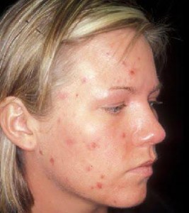 Dry Skin Acne
