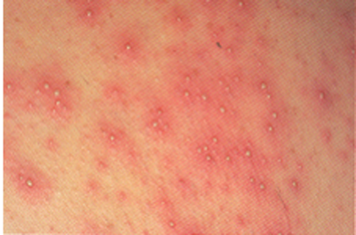 Cipro Yeast Infection